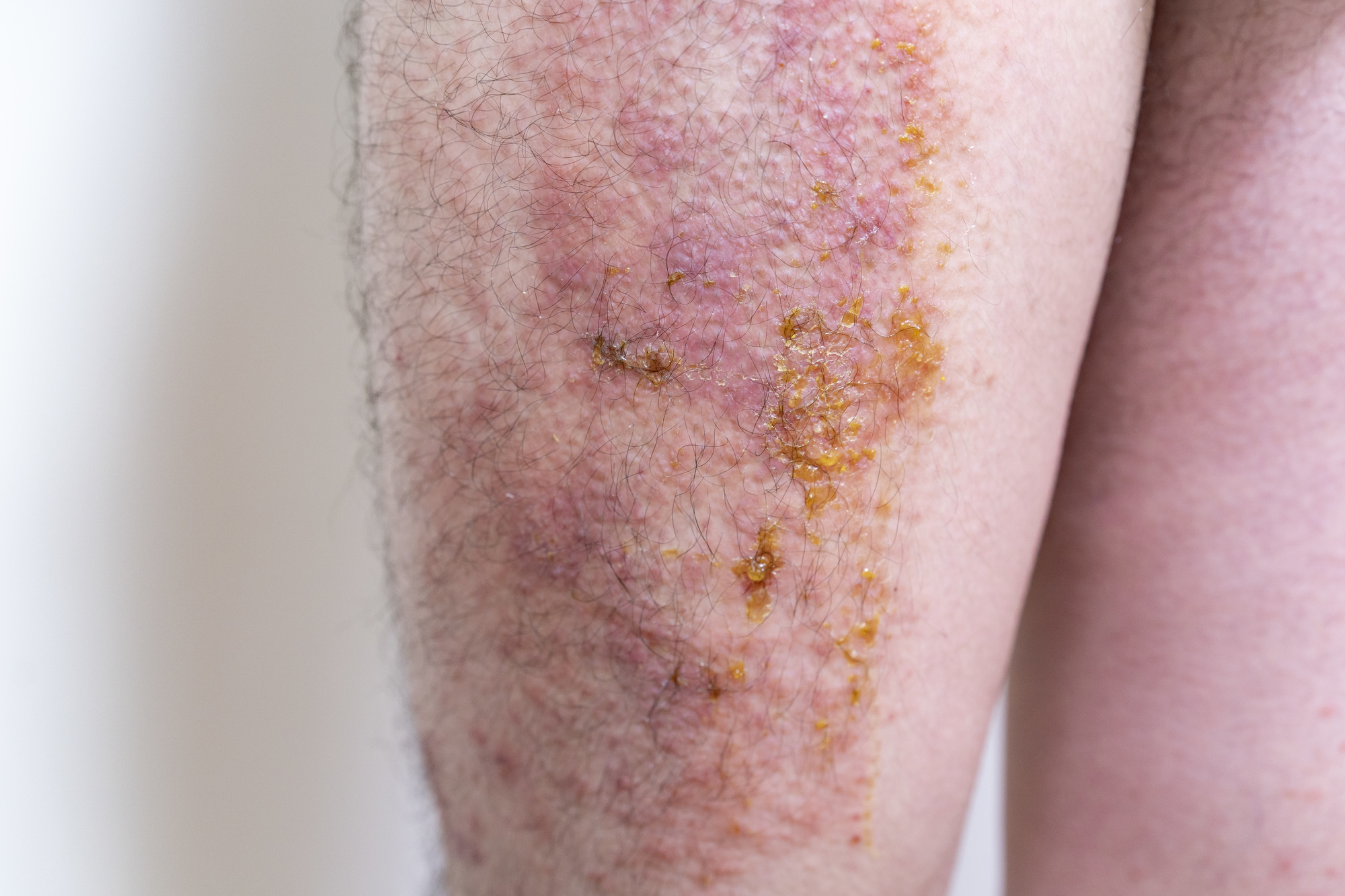 疱疹状皮膚炎はどのように診断されますか?