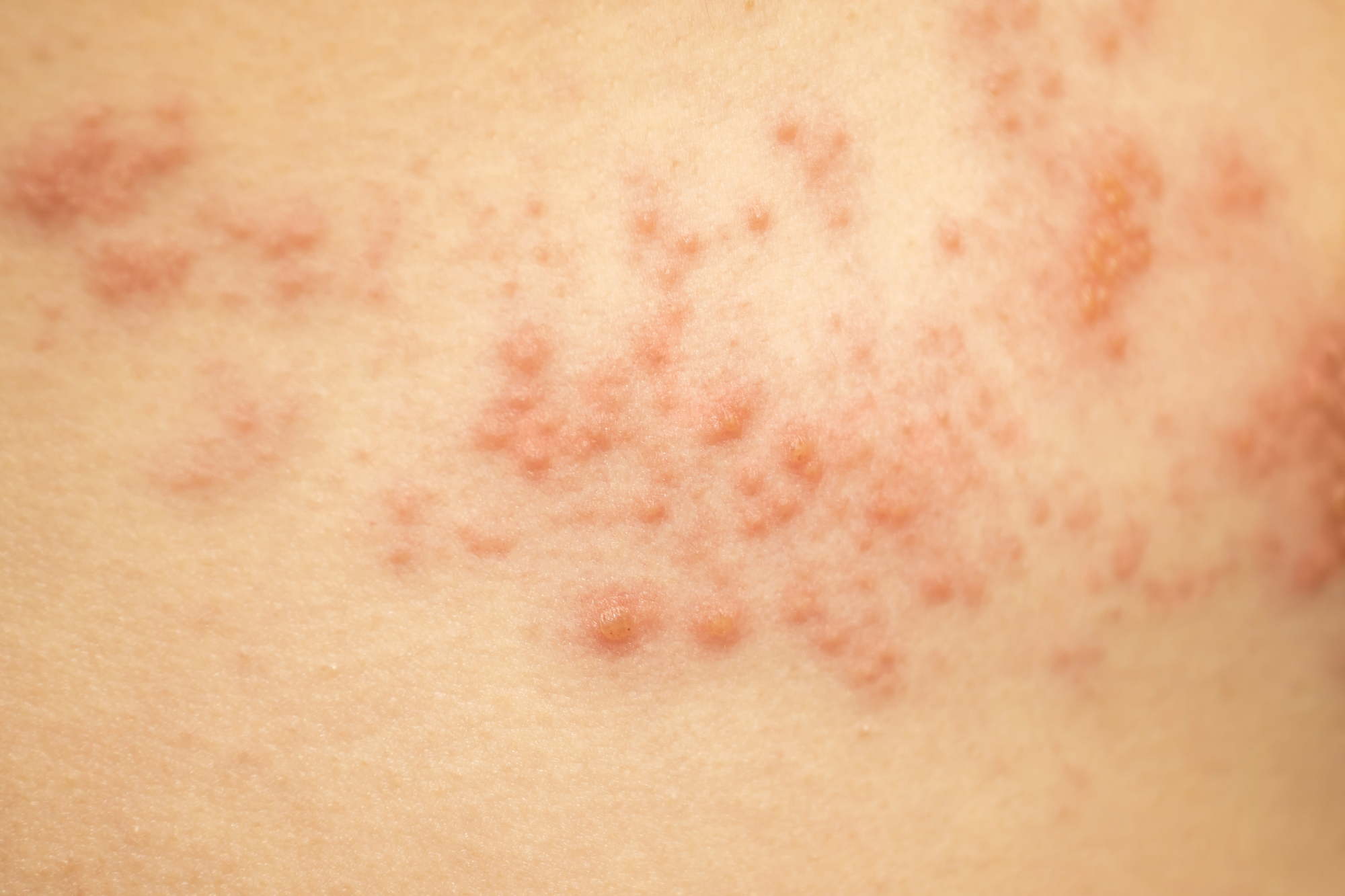 湿疹とは何ですか?