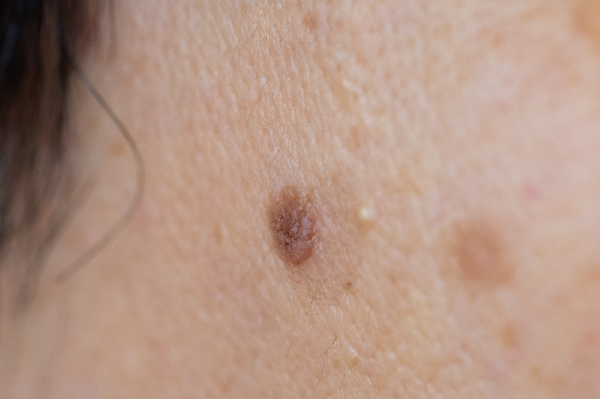 イチゴ母斑の写真